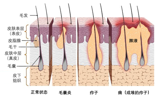 这种“红包”又痛又肿 硬挤真的很危险