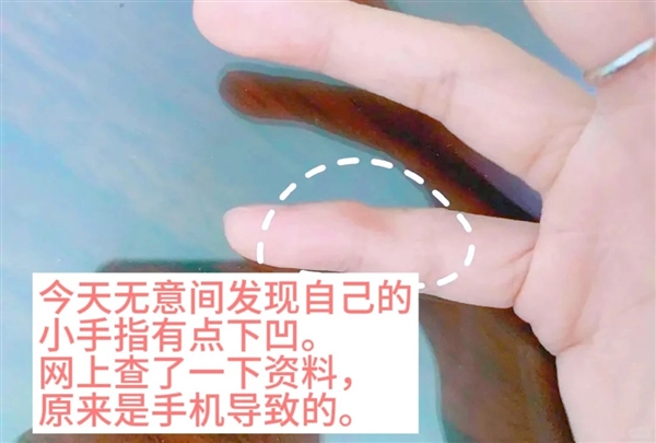 用小拇指做手机支架的受害者出现了：手指出现明显凹痕